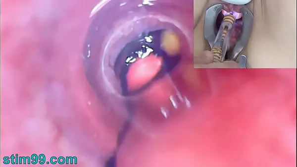 Video caldi Fotocamera per endoscopio Peehole donna matura in vescica con pallecaldi